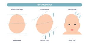 plagiocefalia bebé